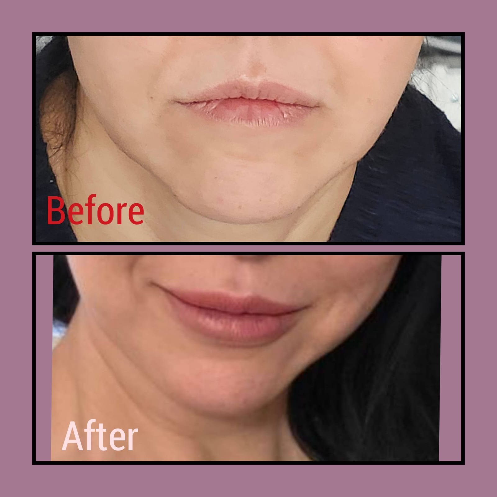 Before and after lip and chin filler treatment at MJ Aesthetics, North York, Toronto