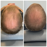 Before and after Exosome Based Treatments aesthetic treatment in North York Toronto