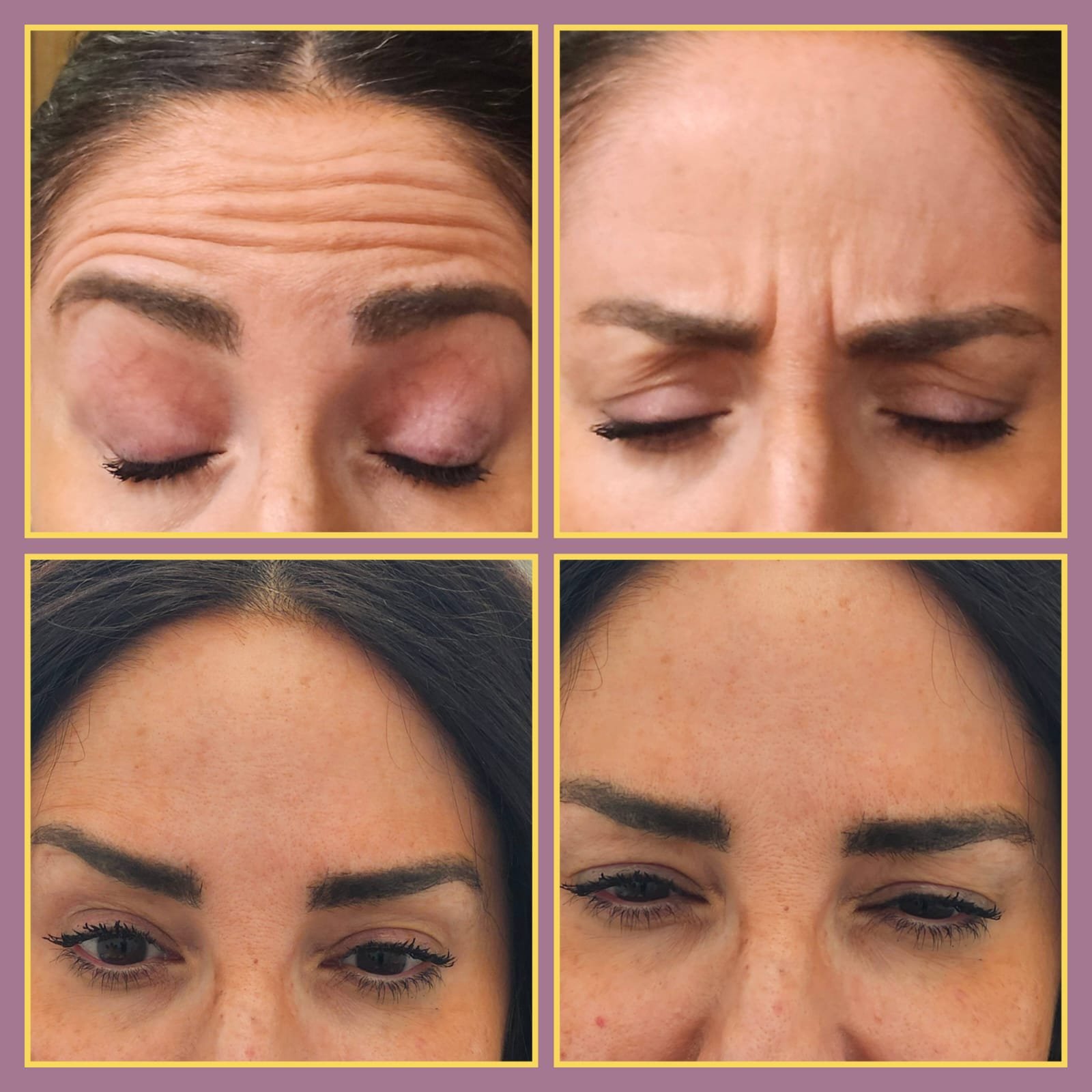 Close-up of a Botox injection being applied to the forehead at MJ Aesthetics, North York