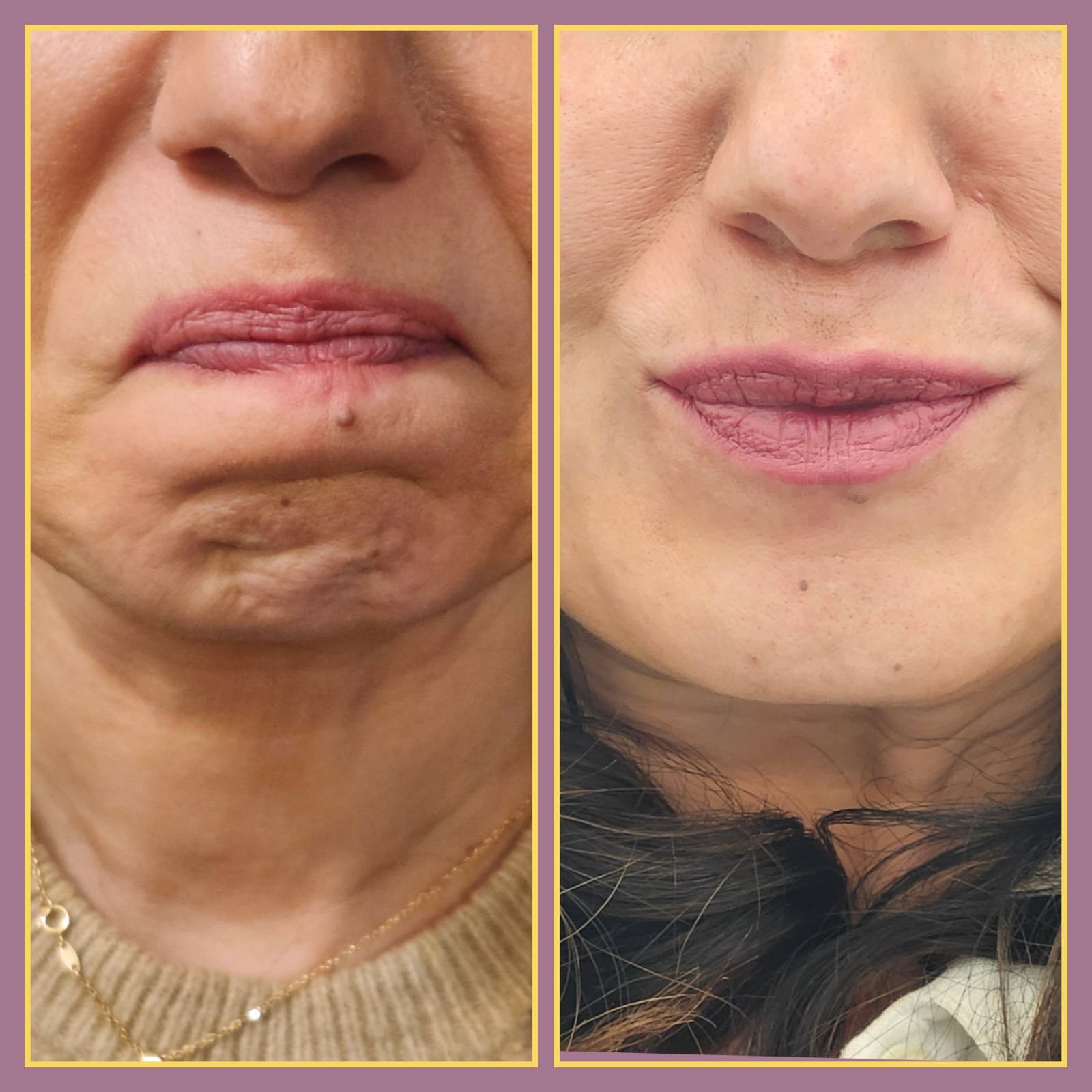 Before and after Botox treatment results with Mehran Javidan, IMG, at MJ Aesthetics, North York, Toronto