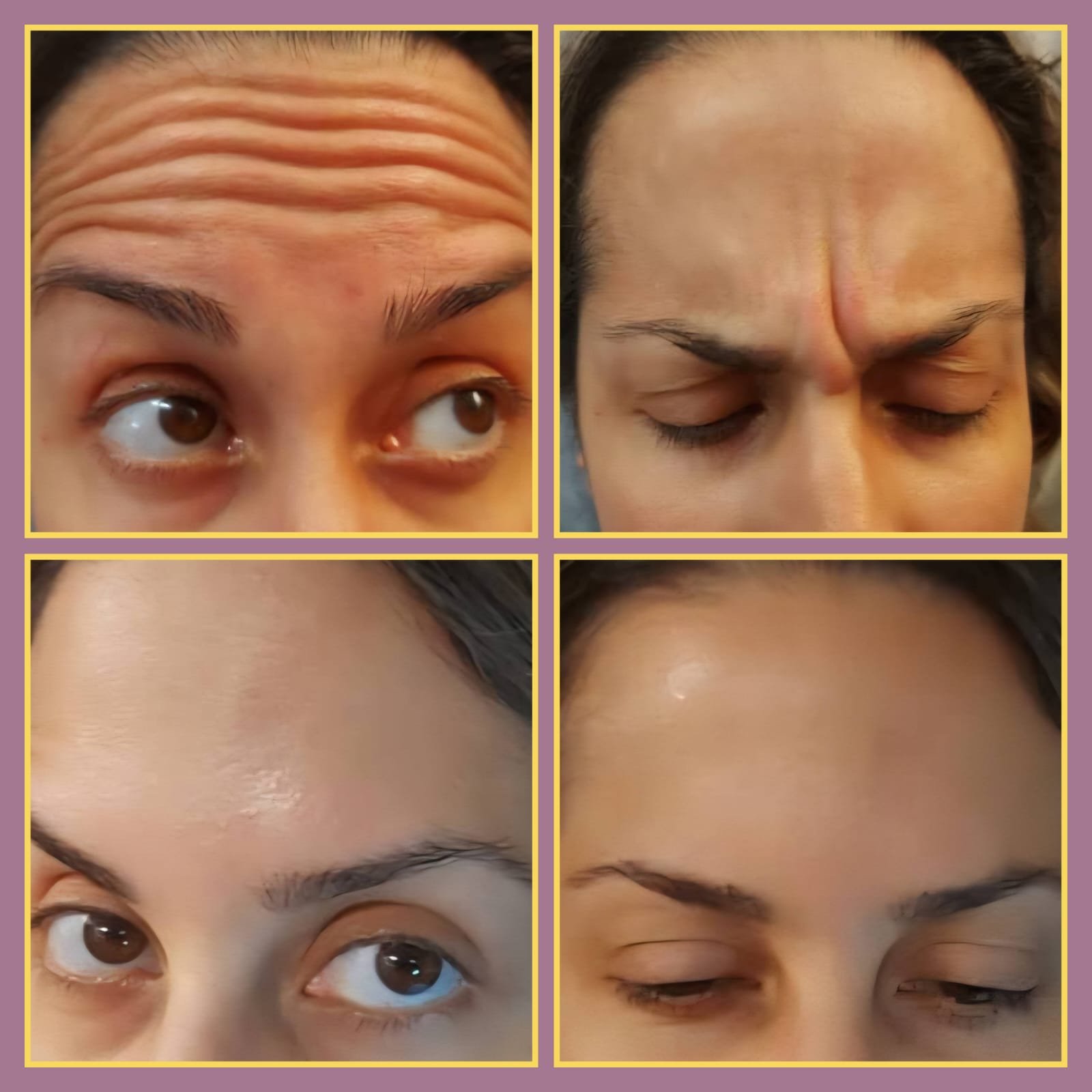 Before and after forehead Botox treatment results with Mehran Javidan, IMG, at MJ Aesthetics, North York, Toronto