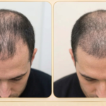 PRP Hair Restoration in North York MJ Aesthetics