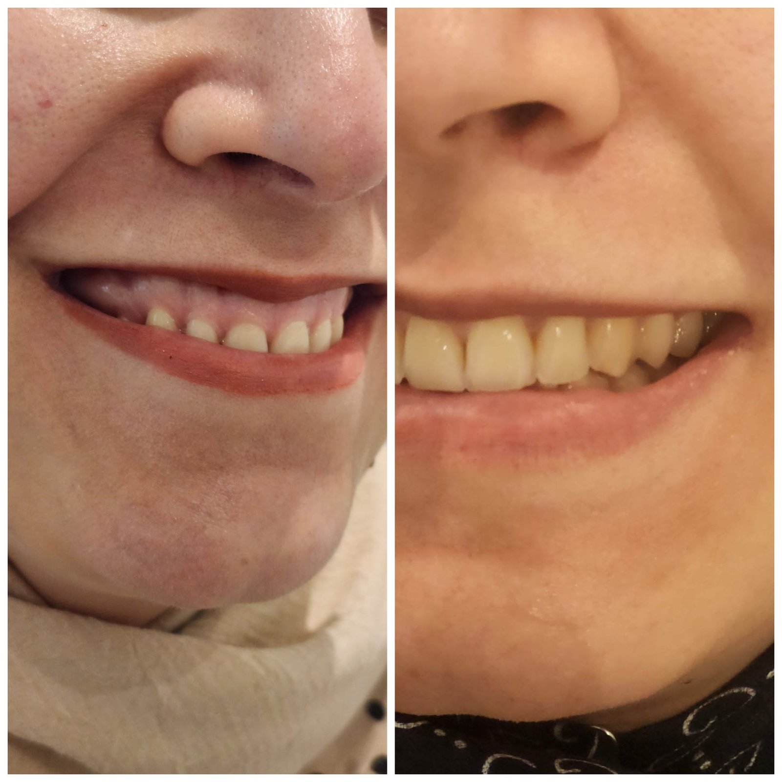 Gummy smile treatment with Botox at MJ Aesthetics, North York, Toronto