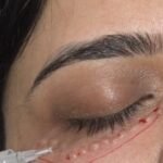 Under eye whitening mesoboosters