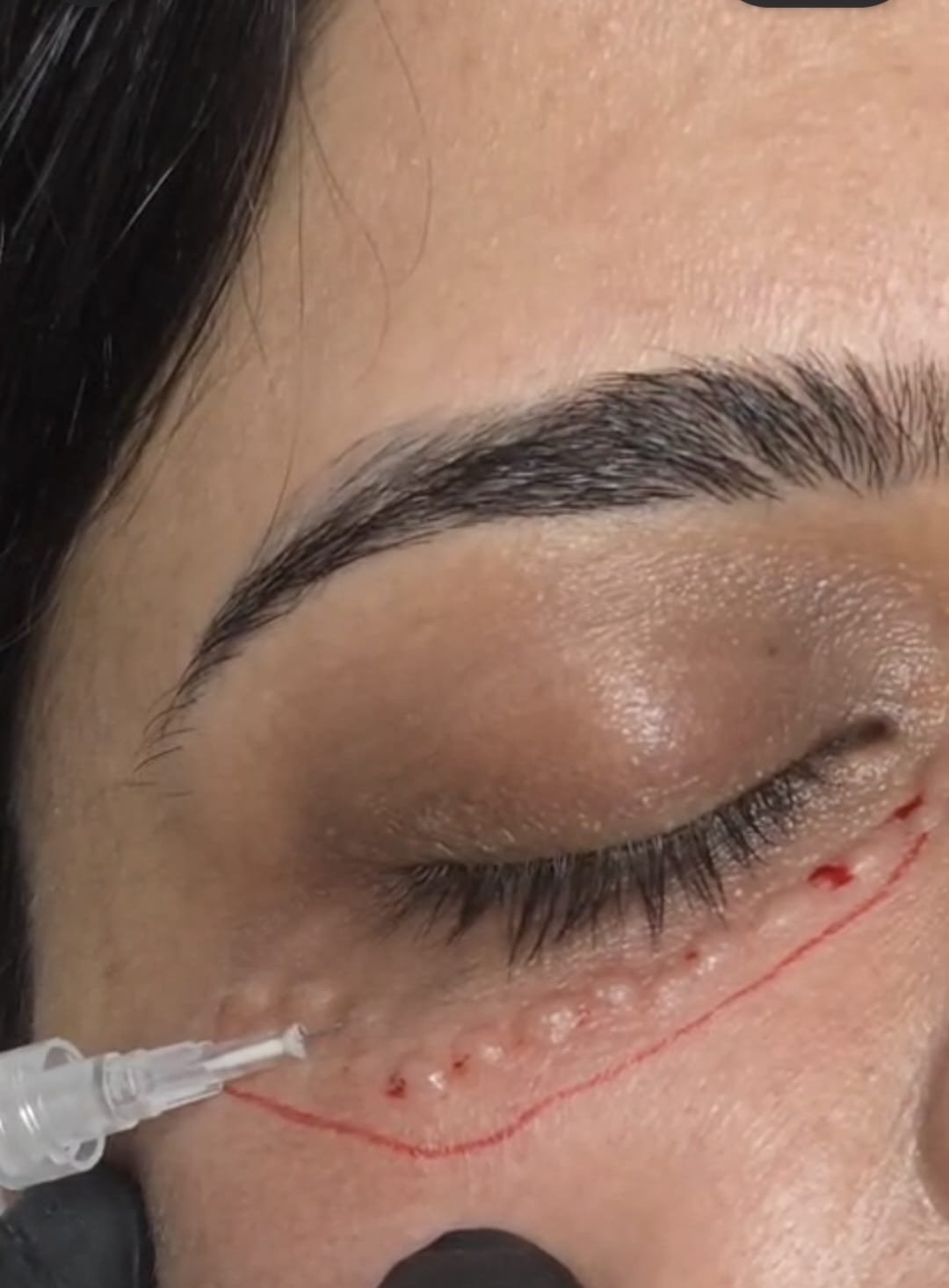 Under-eye whitening mesobooster treatment procedure at MJ Aesthetics, North York, Toronto