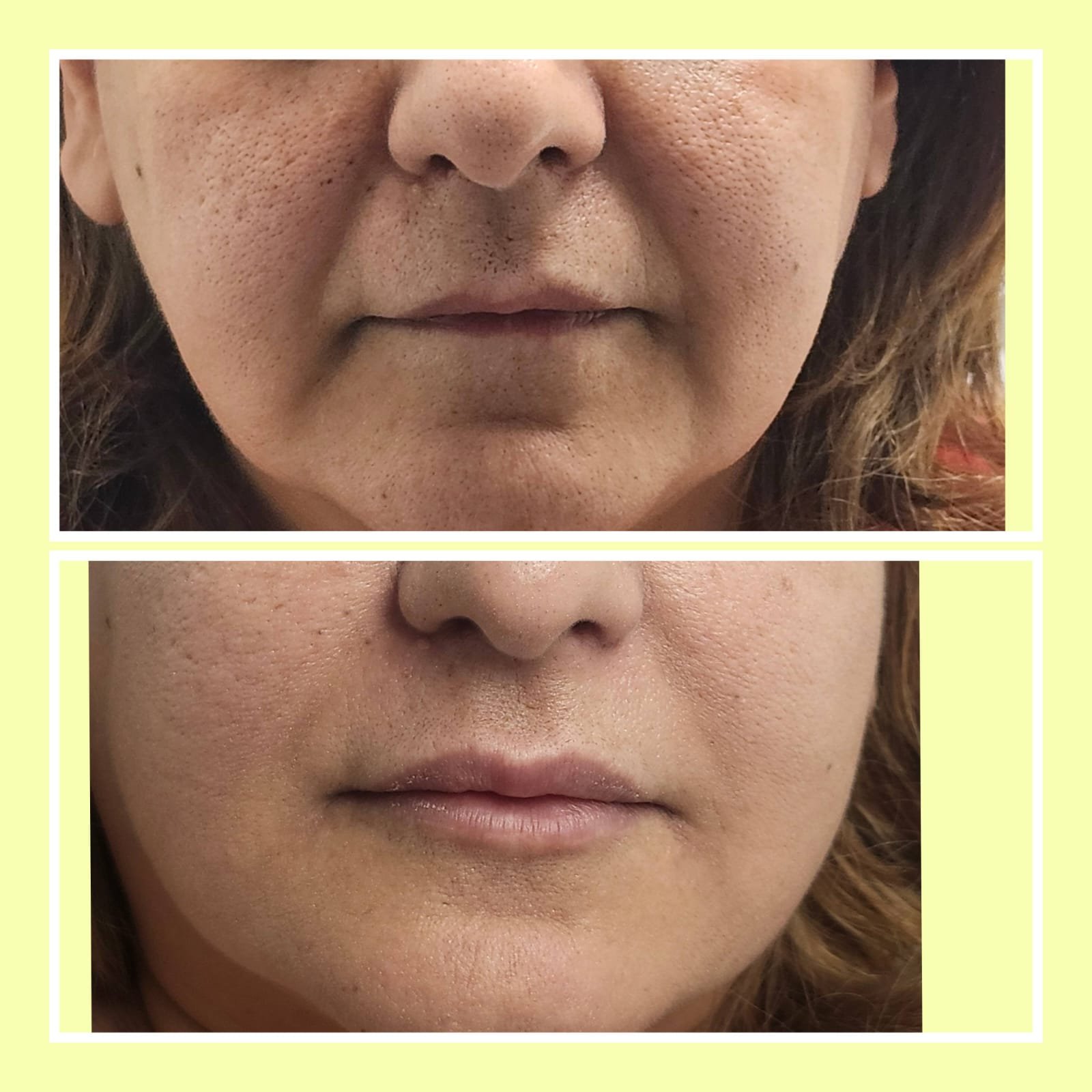 Before and after lip filler treatment results at MJ Aesthetics, North York, Toronto