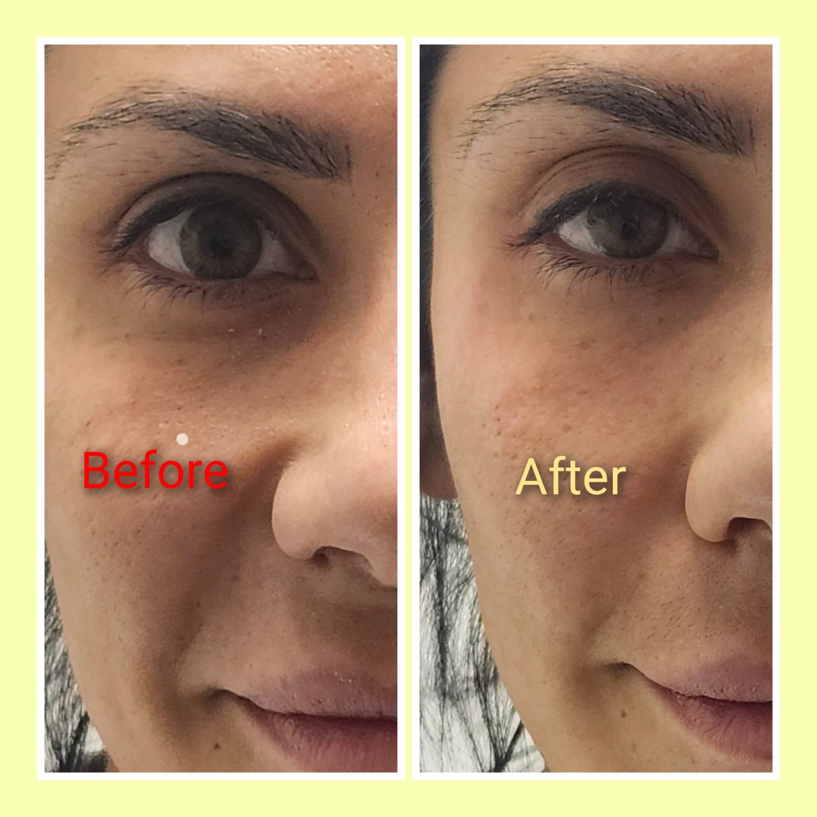 Before and after under-eye whitening mesobooster treatment at MJ Aesthetics, North York, Toronto