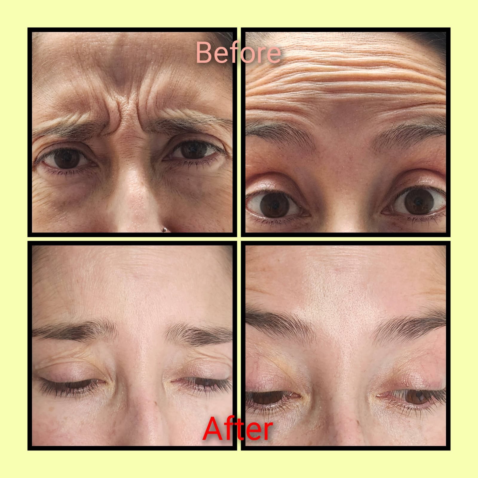 Before and after Botox treatment results at MJ Aesthetics, North York, Toronto