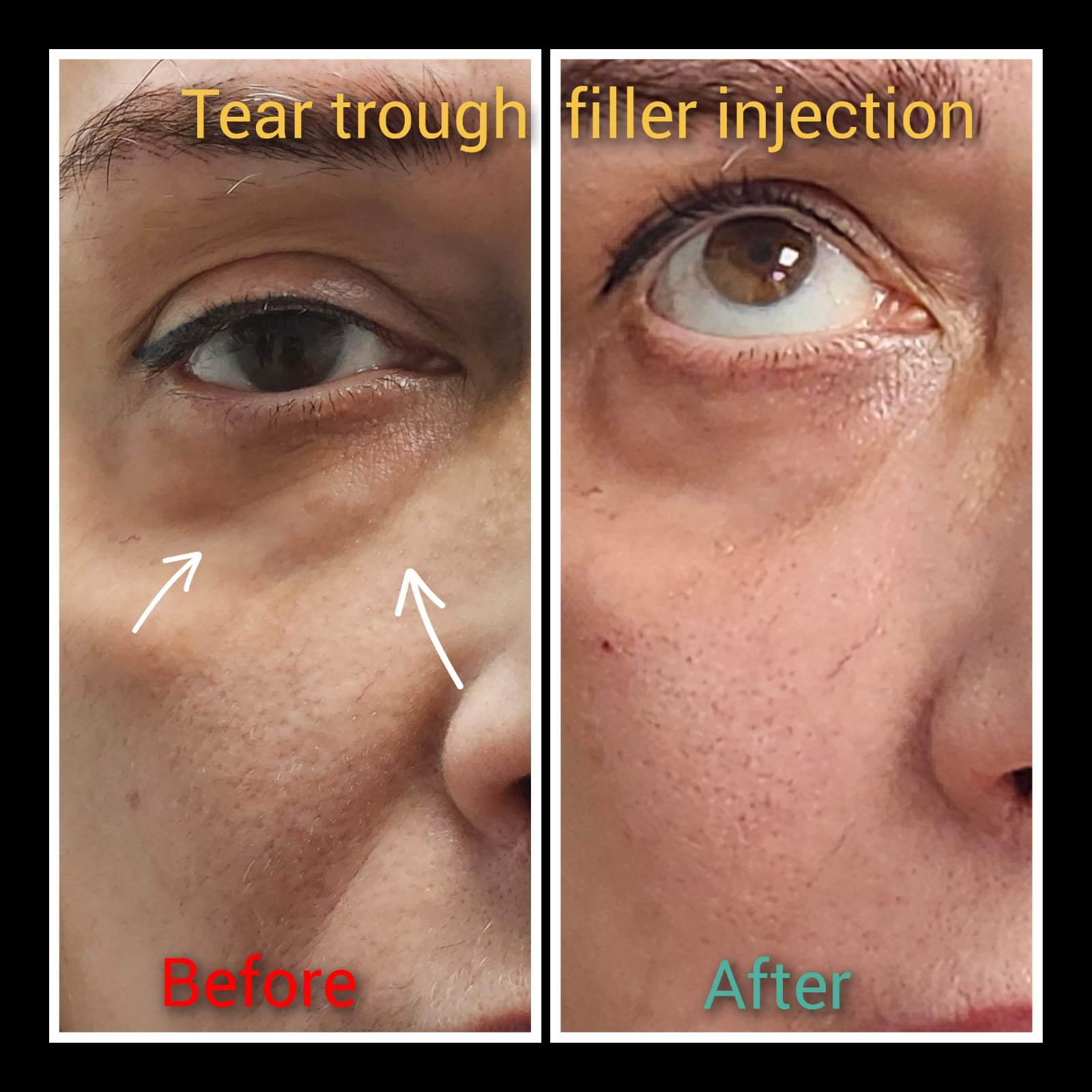 Before and after tear trough filler injection at MJ Aesthetics, North York, Toronto