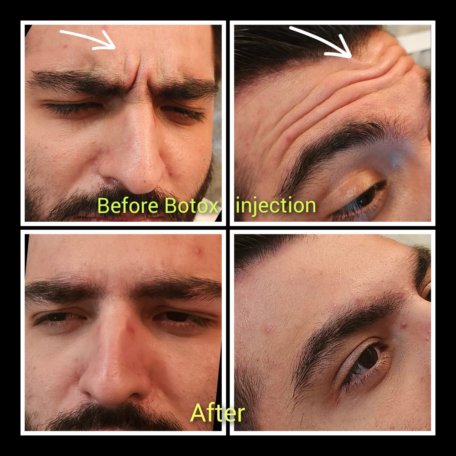 Before and after Botox treatment results with Mehran Javidan, IMG, at MJ Aesthetics, North York, Toronto