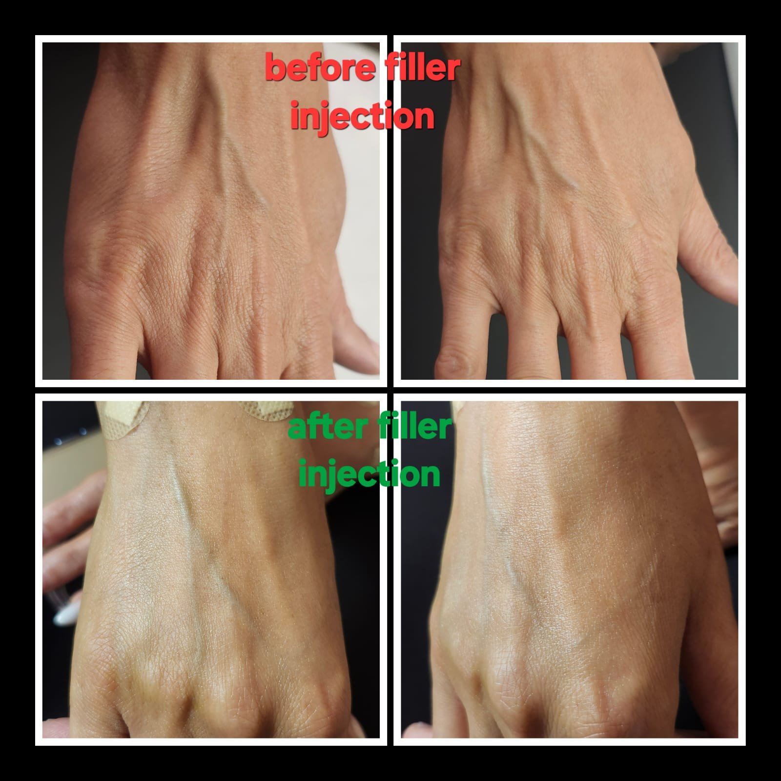 Before and after hand filler treatment at MJ Aesthetics, North York, Toronto