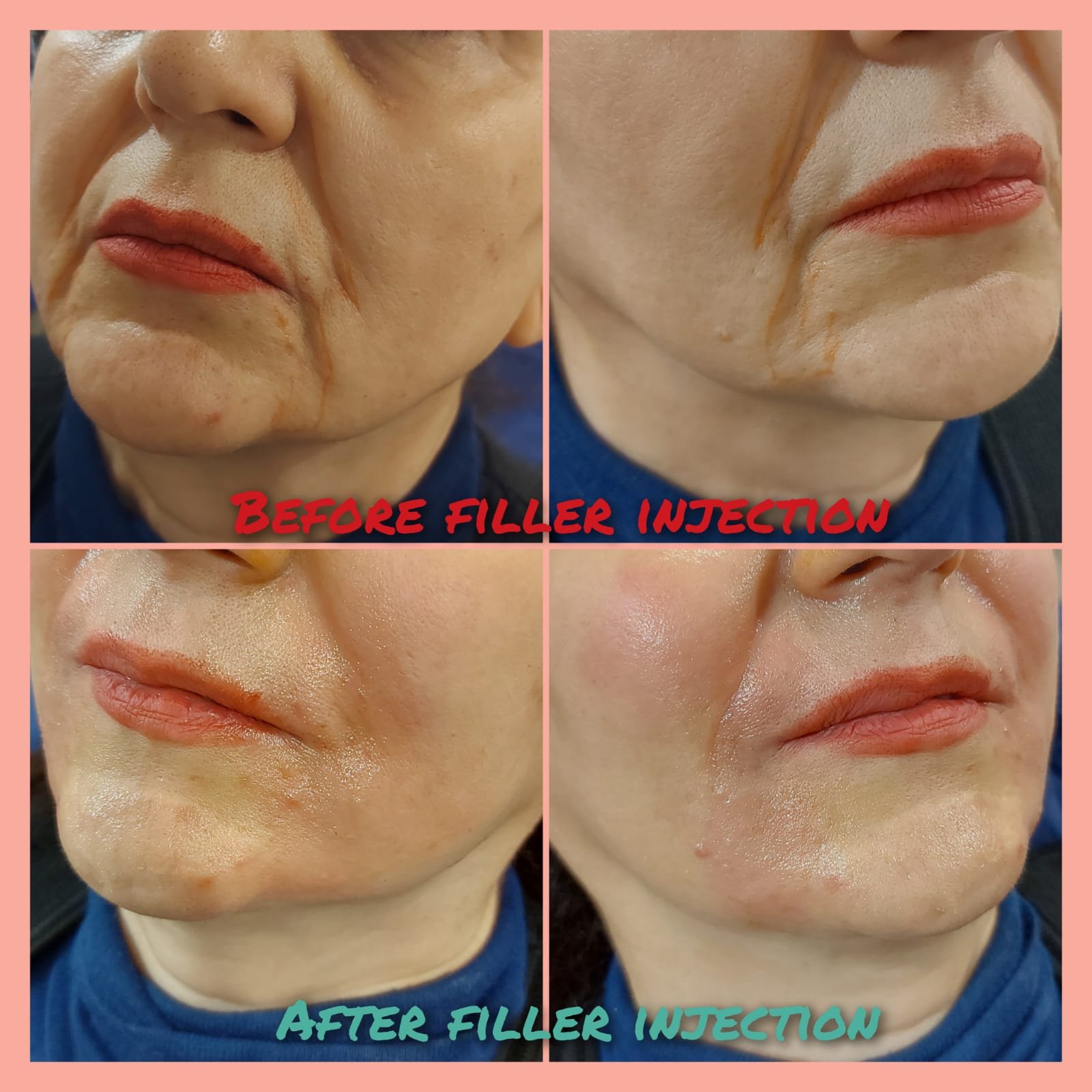 Before and after lip and marionette line filler at MJ Aesthetics, North York, Toronto