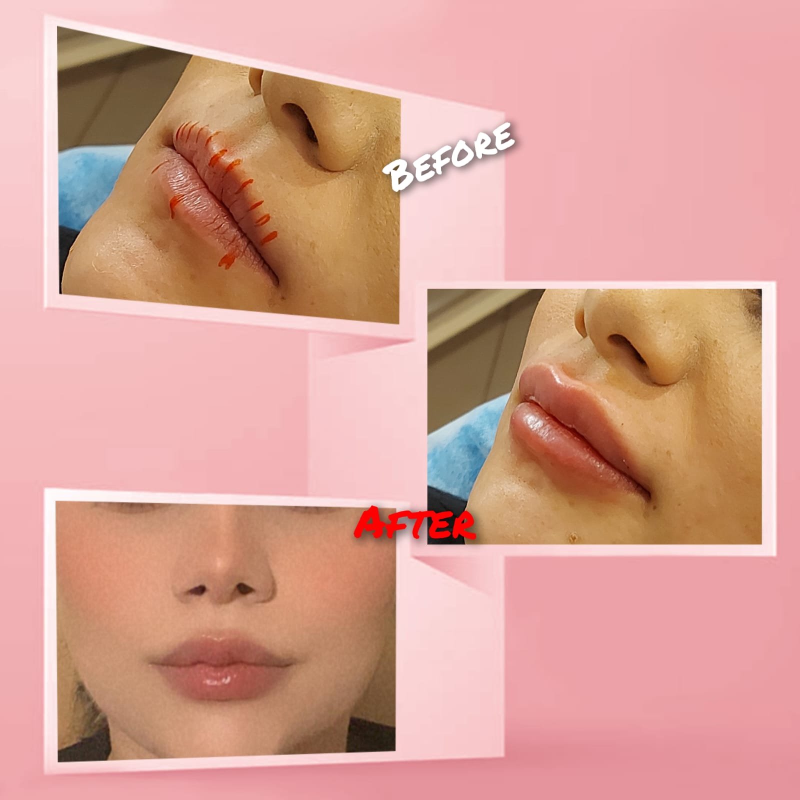 Natural-looking lip filler results at MJ Aesthetics, North York, Toronto