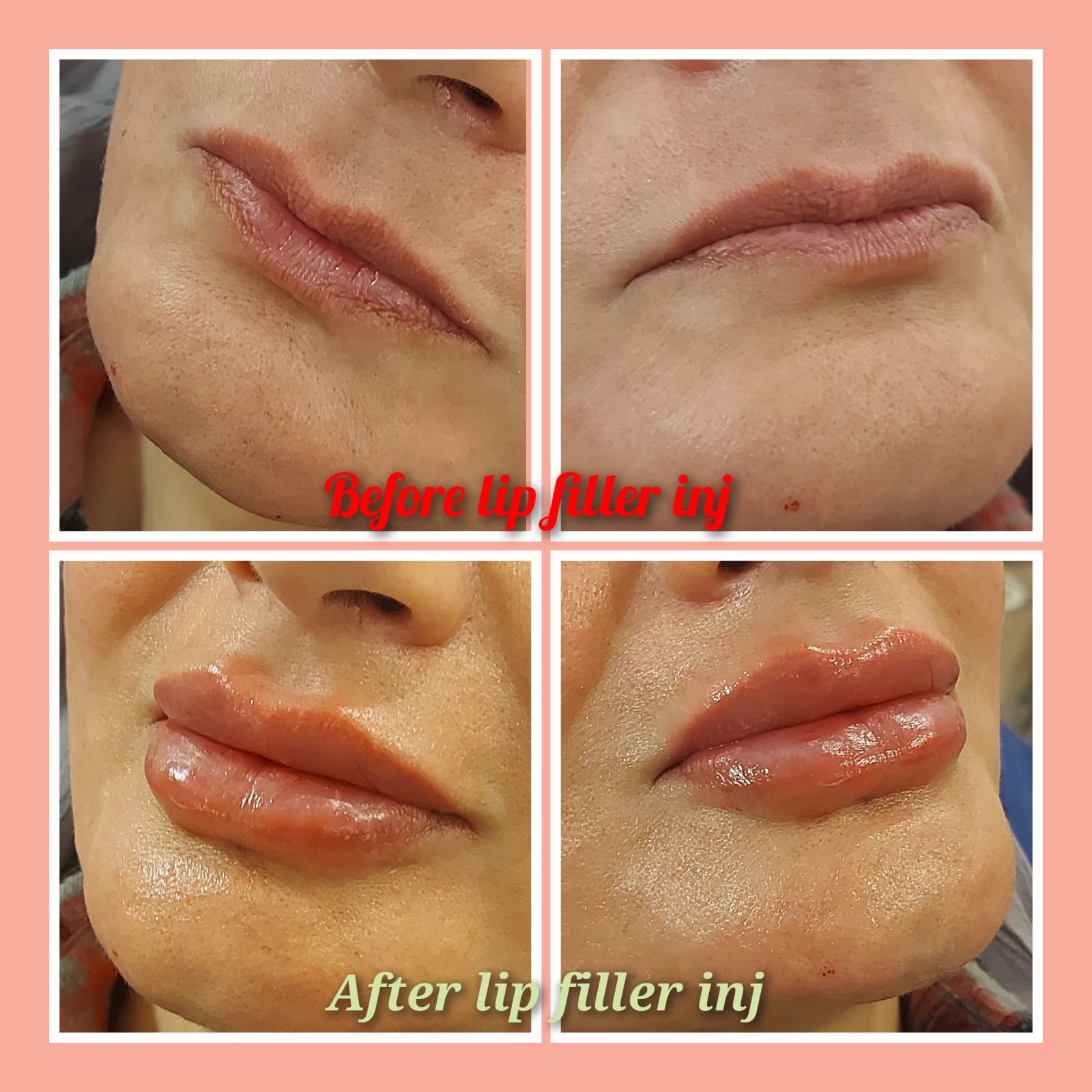 Before and after lip filler injection results at MJ Aesthetics, North York, Toronto