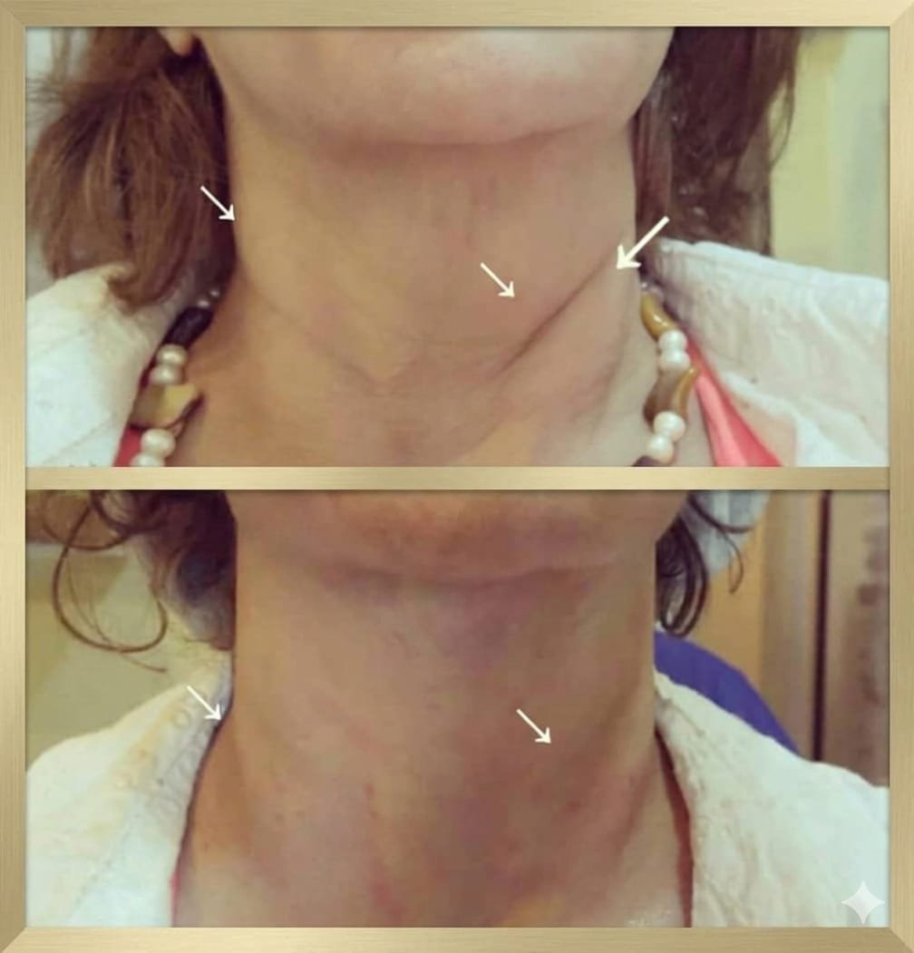 Neck skin quality improvement after treatment at MJ Aesthetics, North York, Toronto