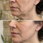 Radiesse & Biostimulators North York | MJ Aesthetics