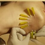 After thread lift treatment showing facial contour changes in North York Toronto