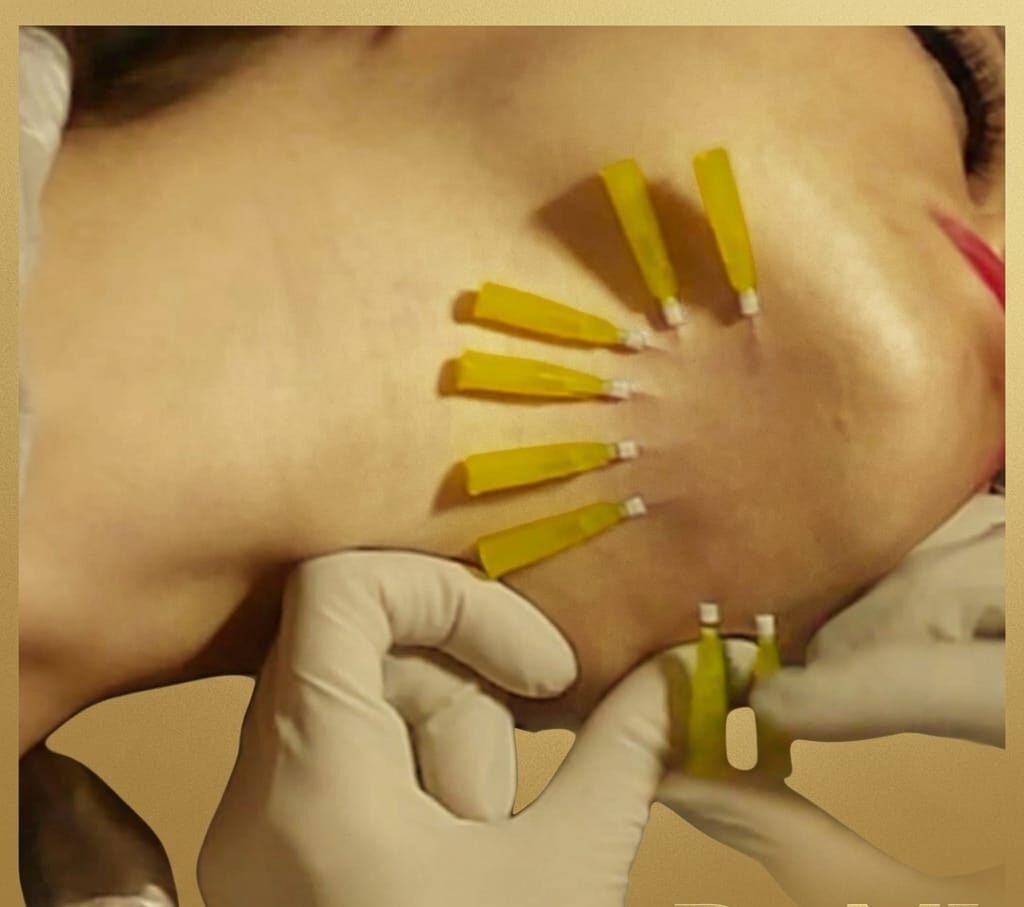 Thread lift procedure being performed on the cheek and jawline at MJ Aesthetics, North York, Toronto