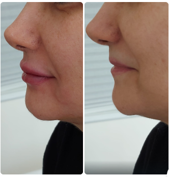 Before and after lip filler results at MJ Aesthetics, North York, Toronto