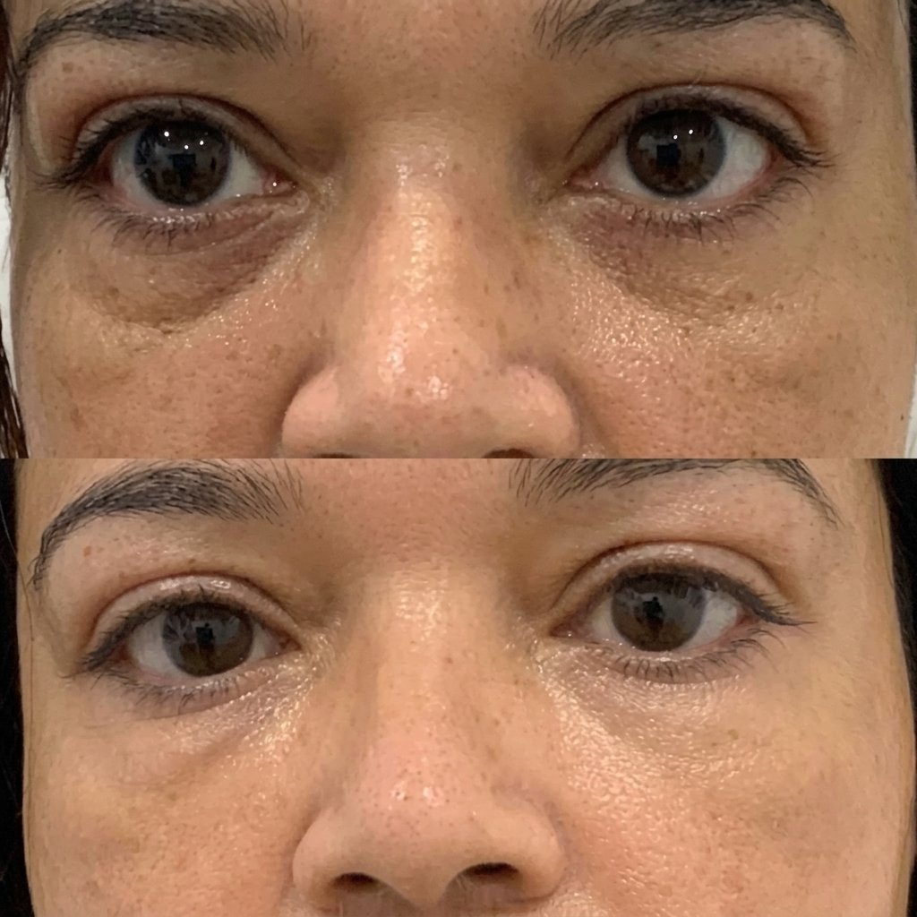 Before and after PRP facial and under-eye rejuvenation results at MJ Aesthetics, North York, Toronto